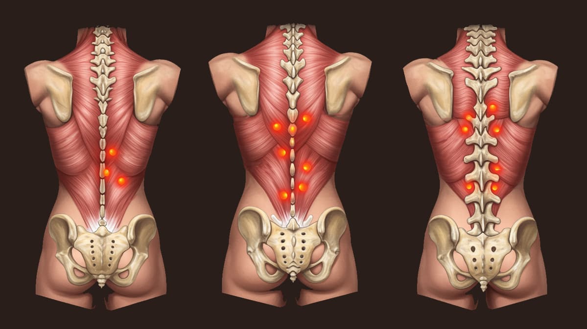 Trigger points : douleurs irradiées et solutions